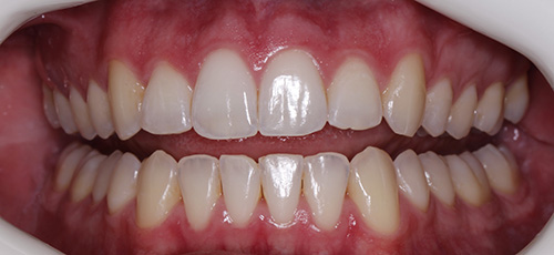 Close up of a mouth after correcting buck teeth