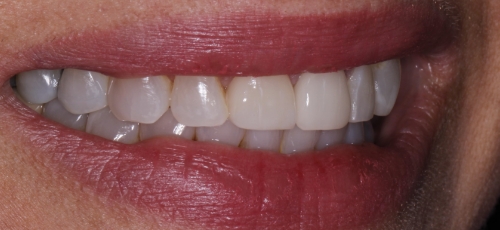 Smile with whiter and evenly aligned teeth