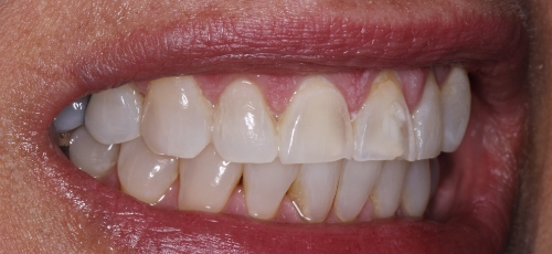 Smile with slightly uneven and discolored teeth