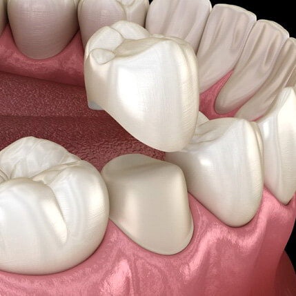 a #D example of a dental crown