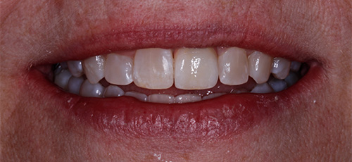 Smile after correcting slightly gapped and discolored teeth