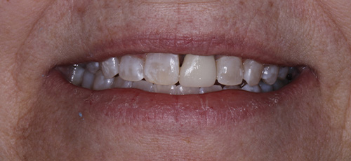 Smile with slightly gapped and discolored teeth
