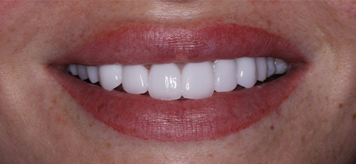 Smile after correcting severe tooth discoloration