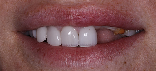 Smile with severe tooth discoloration