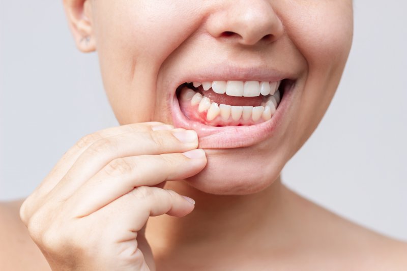 A close-up of a red bump on a woman’s gums